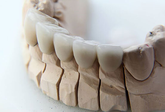 Should You Replace Your Veneers with Crowns?
